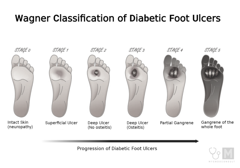 Diabetic Foot Ulcer Stages A Concise Guide My Endo Consult 6065