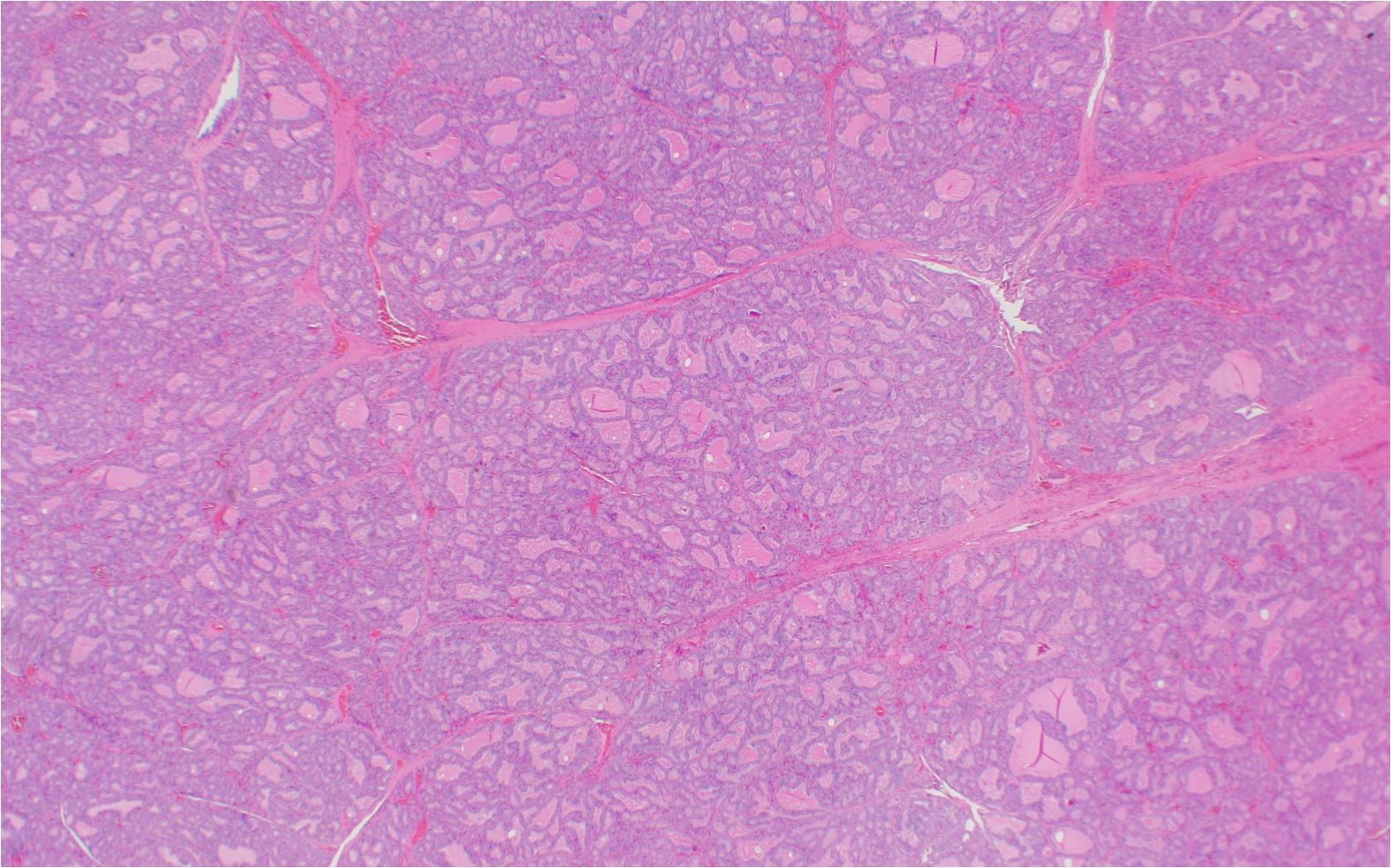 Diffuse folllicular hyperplasia without inflammatory infiltrate clinically associated with graves disease