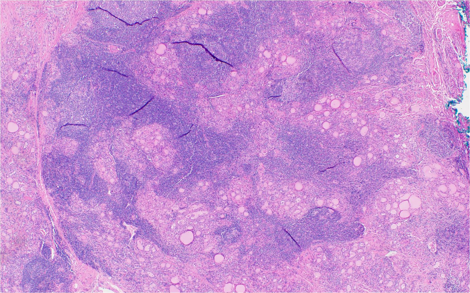 Hashimoto’s thyroiditis characterized by dense lymphoplasmacytic infiltrate of thyroid parenchyma