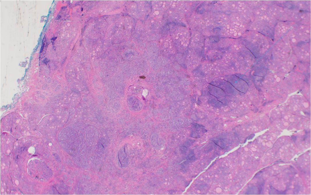 Papillary thyroid carcinoma, conventional-type, occurring in a background of Hashimoto’s thyroiditis Note sclerosis in area of tumor and lymphoid infiltrated in surrounding thyroid (large arrow)
