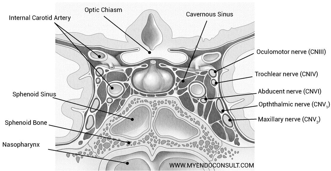 Coronal view of the pituitary gland showing the anatomic relation of the cavernous sinus to the hypophysis