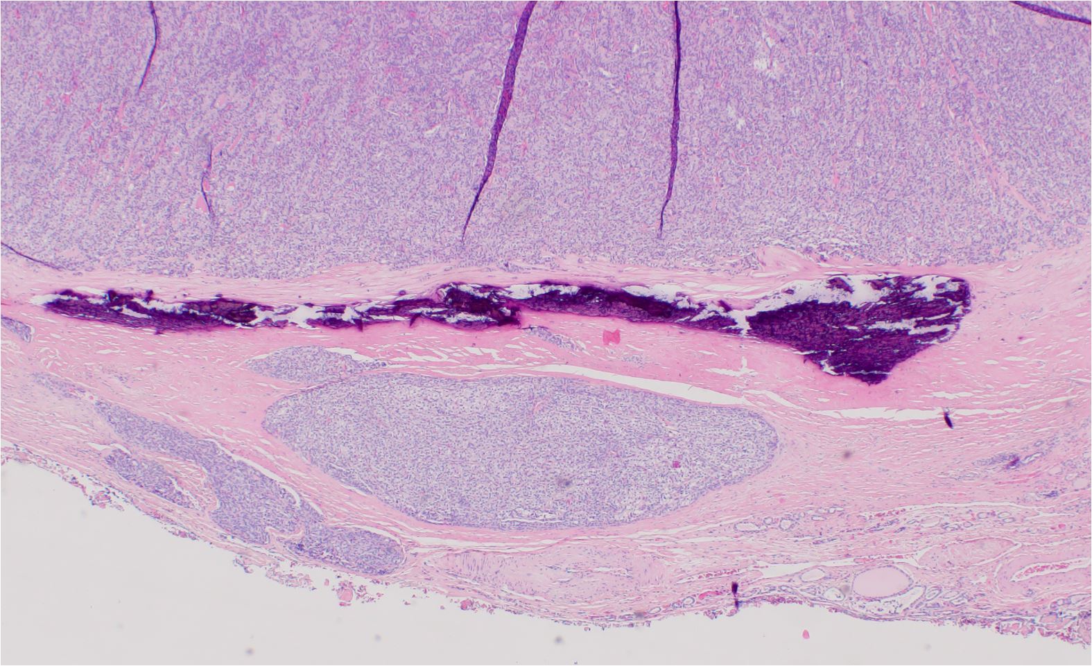 Follicular carcinoma of the thyroid with capsular invasion