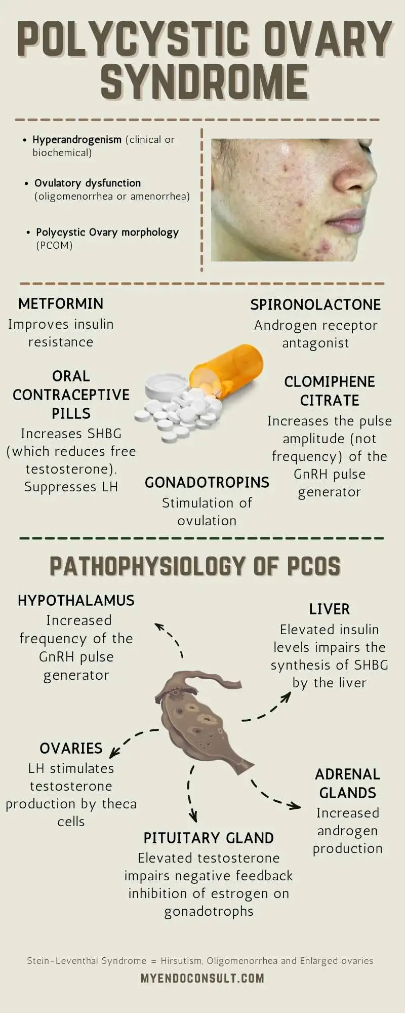 Pathophysiology of PCOS. Summary Infographic