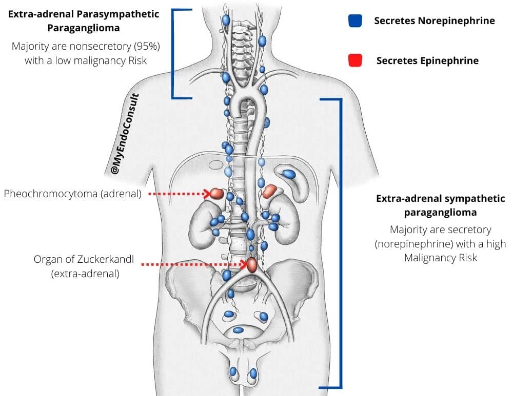 Paraganglioma anatomical positions