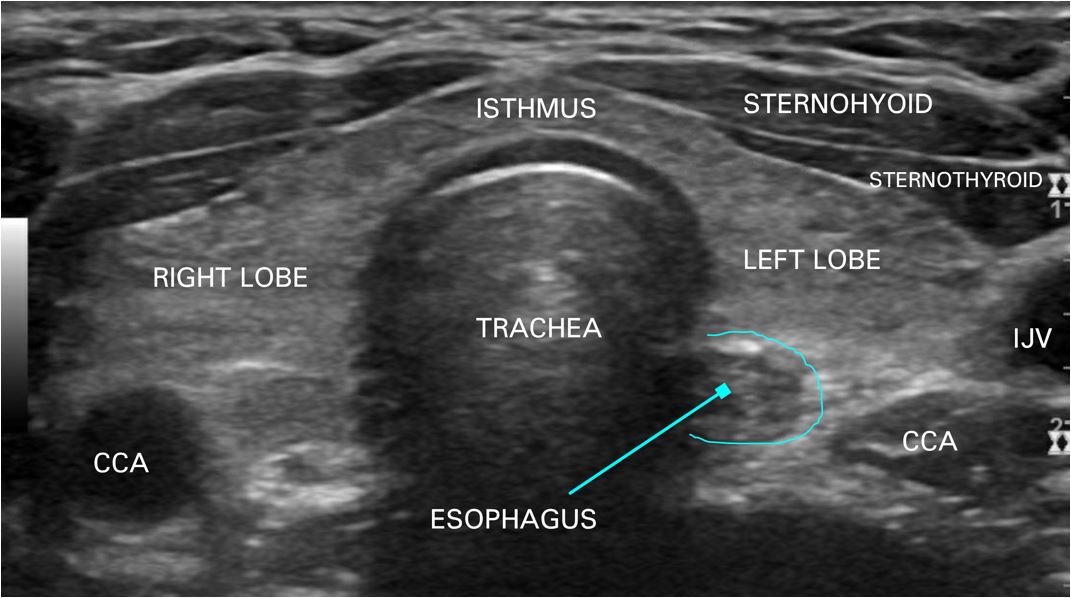 Normal Thyroid Ultrasound Images Myendoconsult